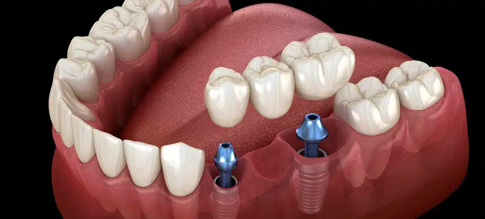 Implantes Dentarios Em Brasilia Como Escolher A Clinica Certa Guia Completo 2025