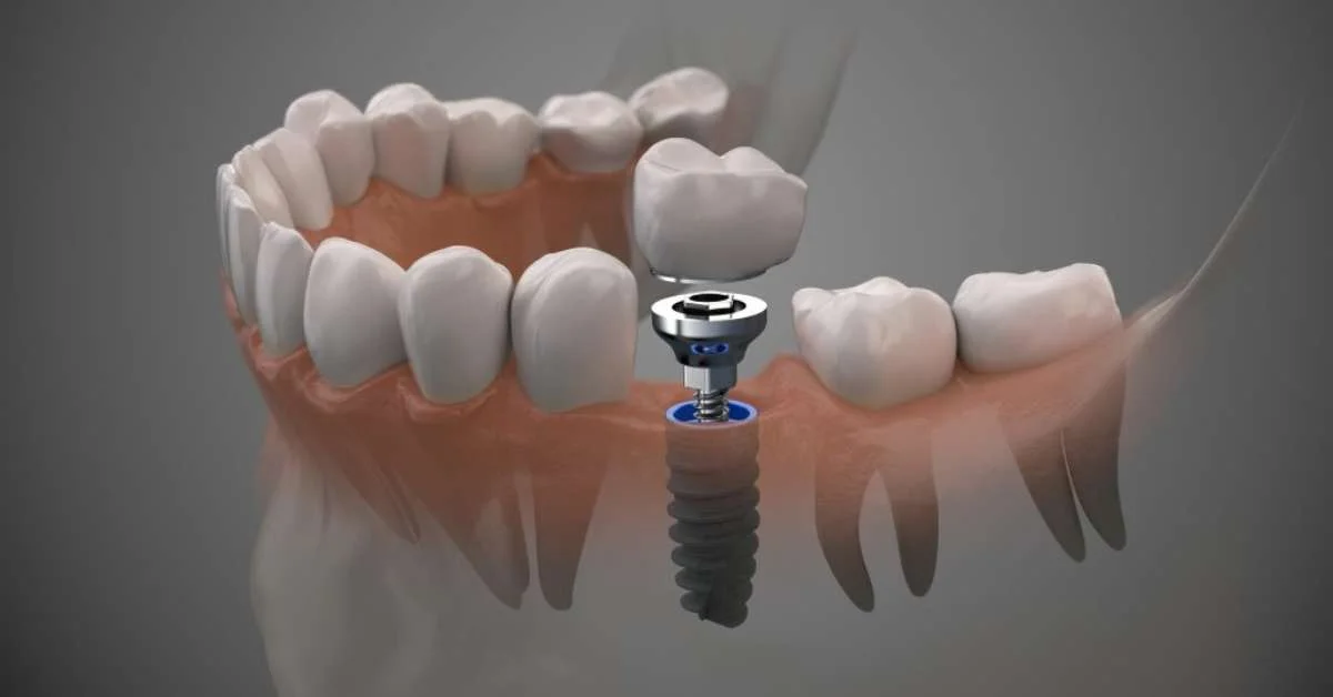 Implantes Dentarios Em Brasilia O Caminho Para Recuperar O Seu Sorriso Com Seguranca E Conforto