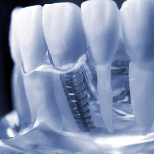 1772560066.protese-protocolo-fixa-sobre-implantes-vital_11zon
