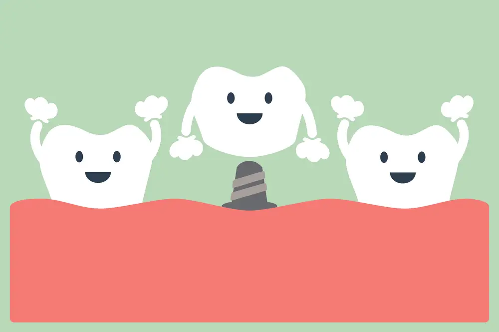 O Que E Preciso Para Fazer Um Implante