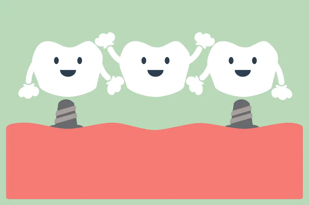 Saiba Tudo Sobre Implantes Dentarios E Fique Por Dentro Do Assunto