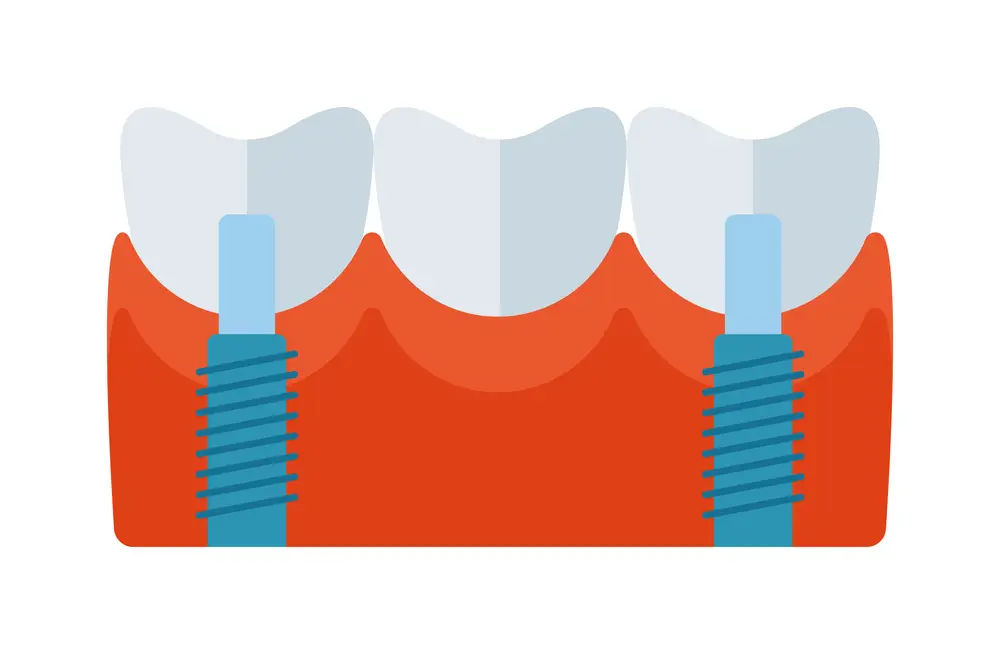 Implante Dentario Doi Tire Essa E Mais 6 Duvidas Sobre Implantes