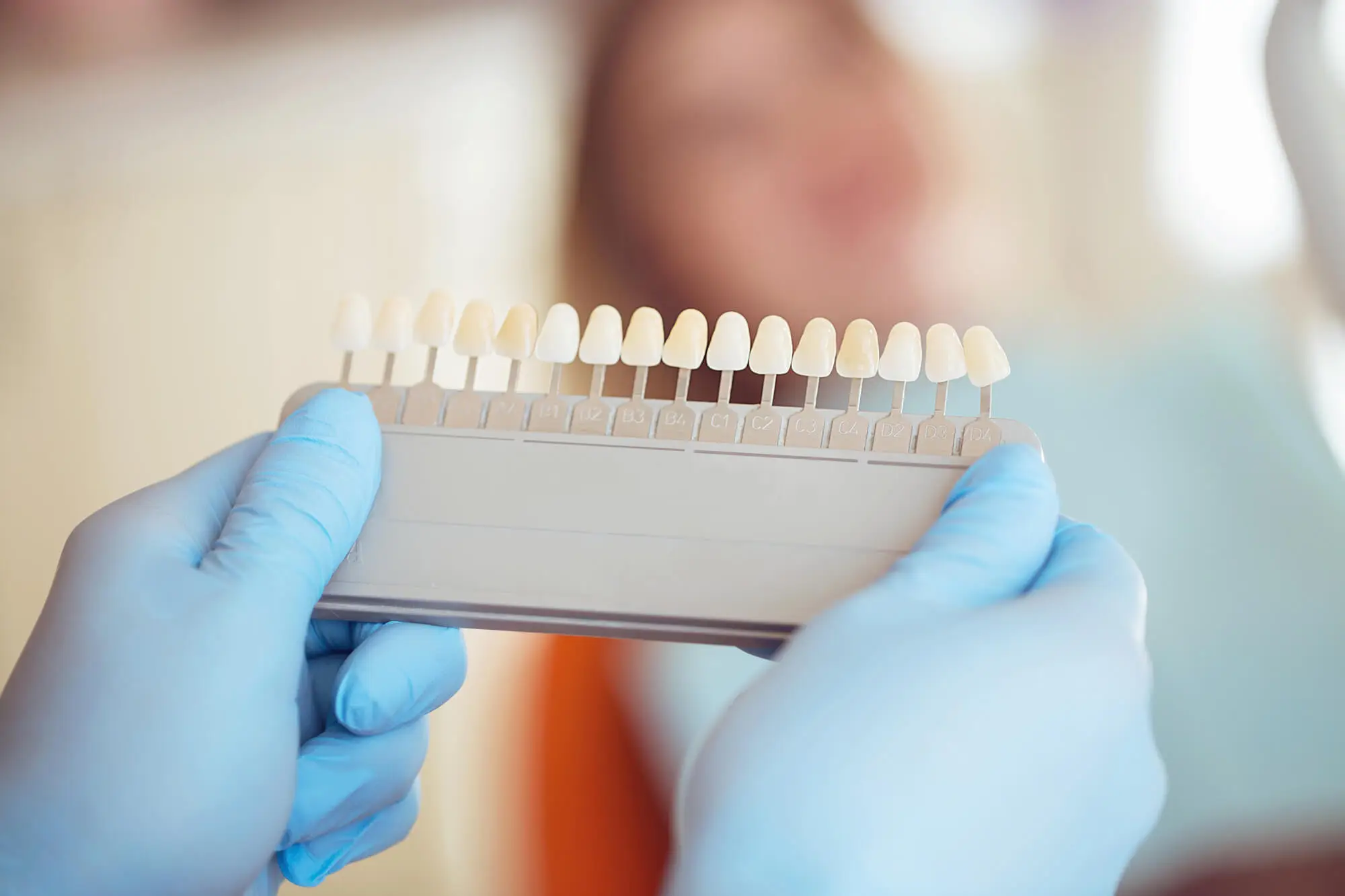 Facetas De Porcelana Tudo O Que Voce Precisa Saber Sobre O Assunto