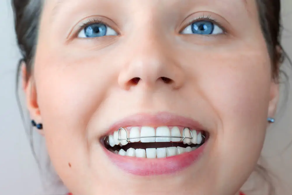 Tire Aqui Suas Duvidas Sobre Aparelho Ortodontico Movel