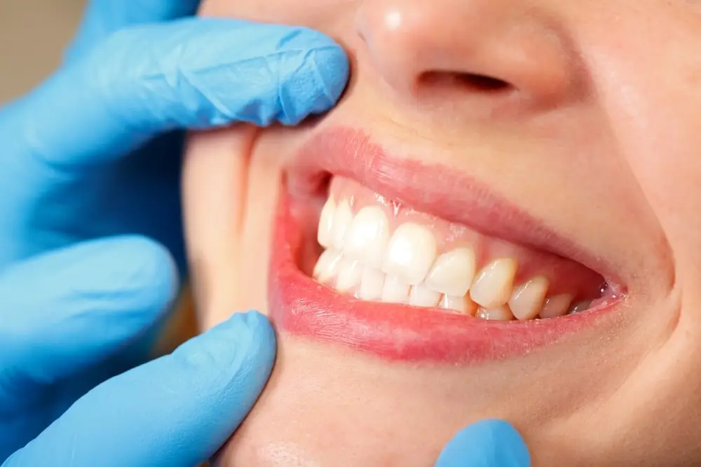 Entenda Como E A Plastica Gengival