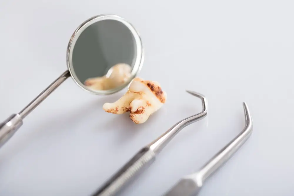 Descubra Agora Como Evitar A Perda Dentaria