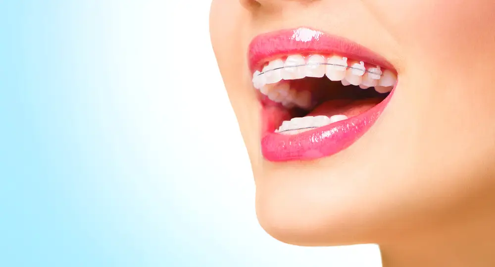 Lente De Contato Dental 5 Curiosidades Sobre Essa Tendencia