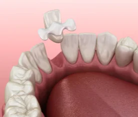 Mordida Cruzada Conheca Os Prejuizos Para Saude Bucal