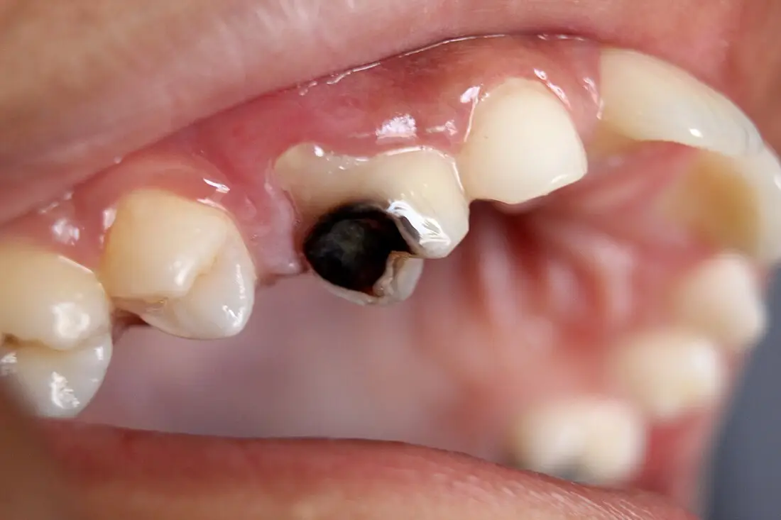 Dente Com Carie Profunda Como Prevenir E Qual O Tratamento